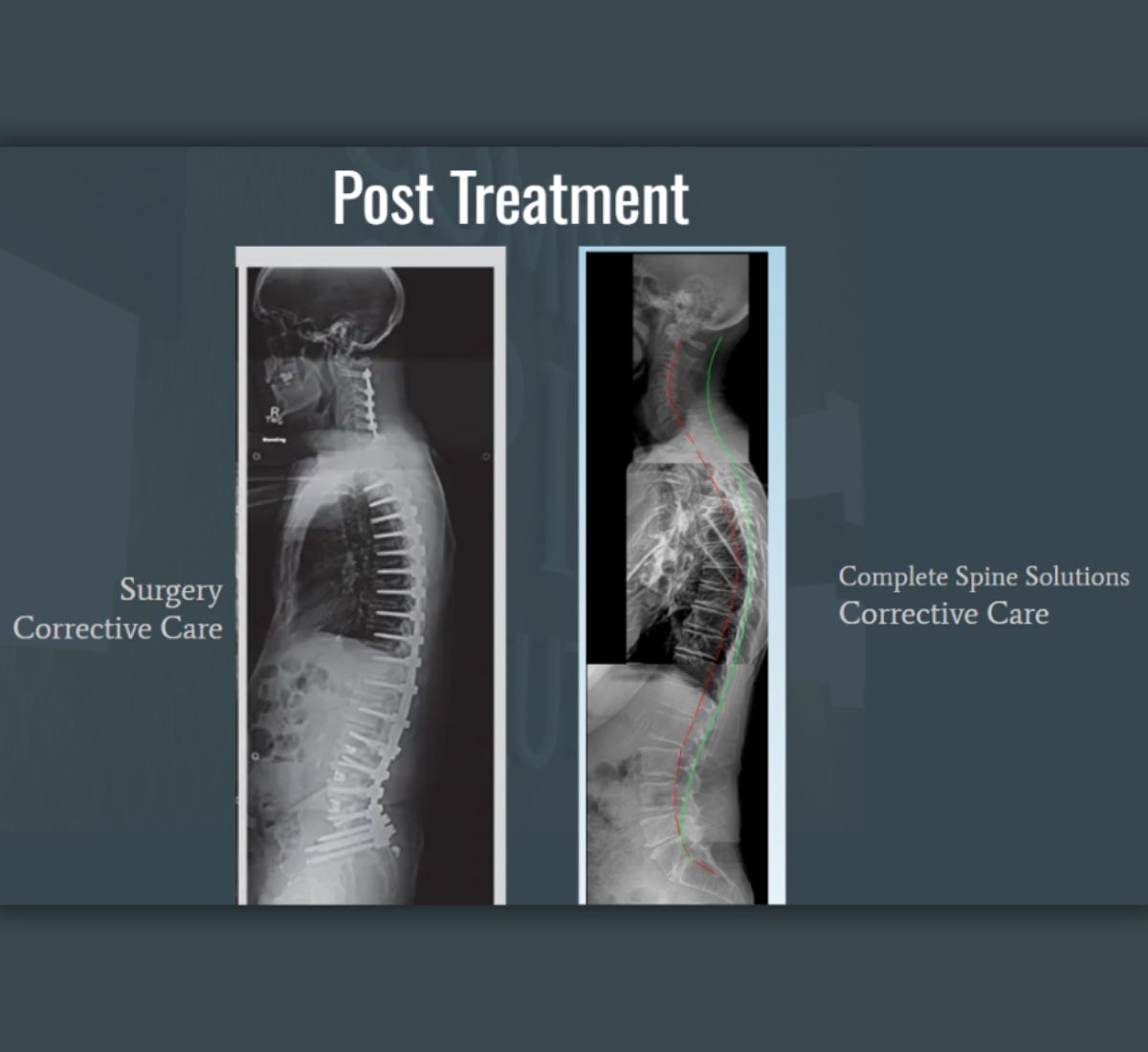 Avoid Back Surgery 1 spine surgery alternative