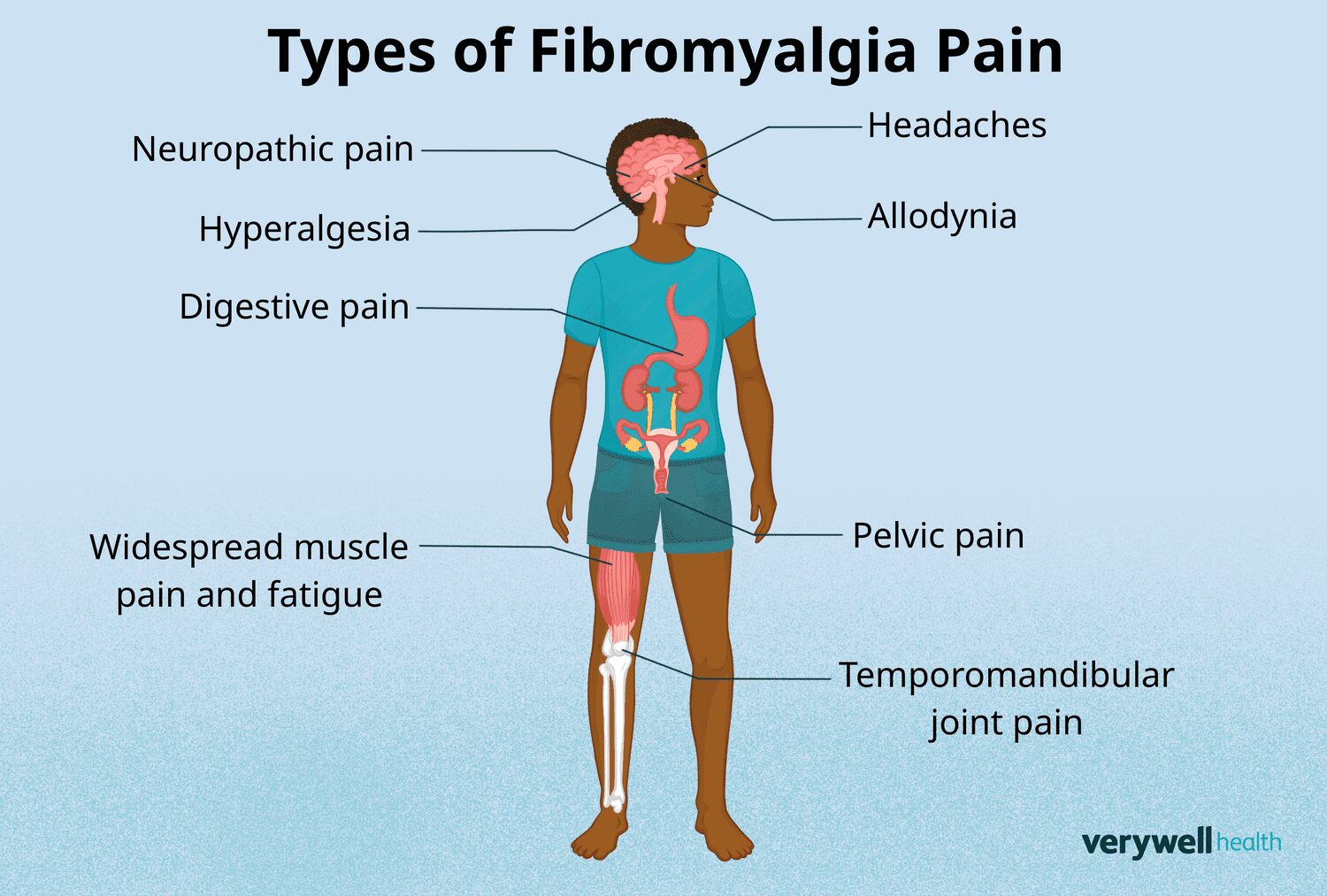 Fibromyalgia