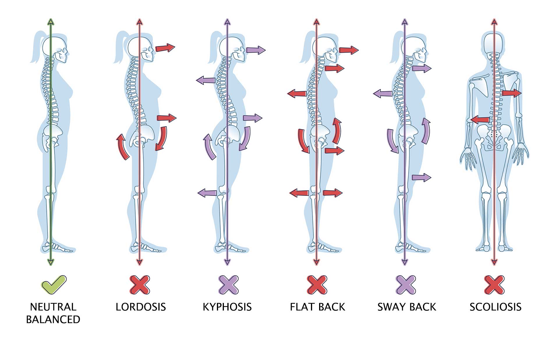 Kyphosis (Hyperkyphosis / Hunchback / Dowager's Hump) Can Lead to Early Death 1 Kyphosis