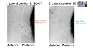 Blog 2 How a Man with a Broken Back Ran a Half Marathon