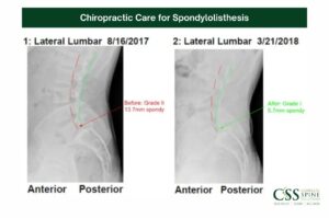 Blog 5 Spondylolisthesis Chiropractic care