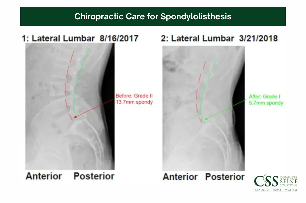 Spondylolisthesis Chiropractic care