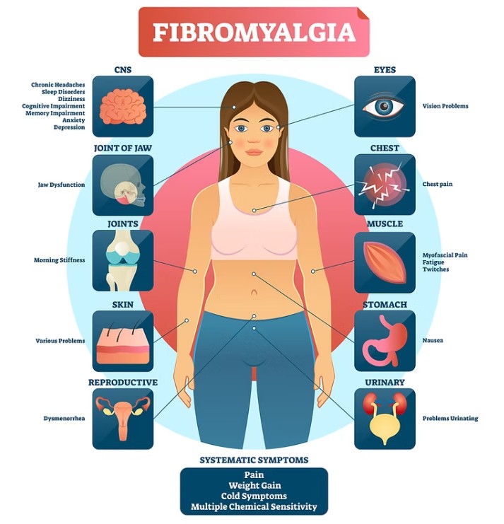 fibromyalgia