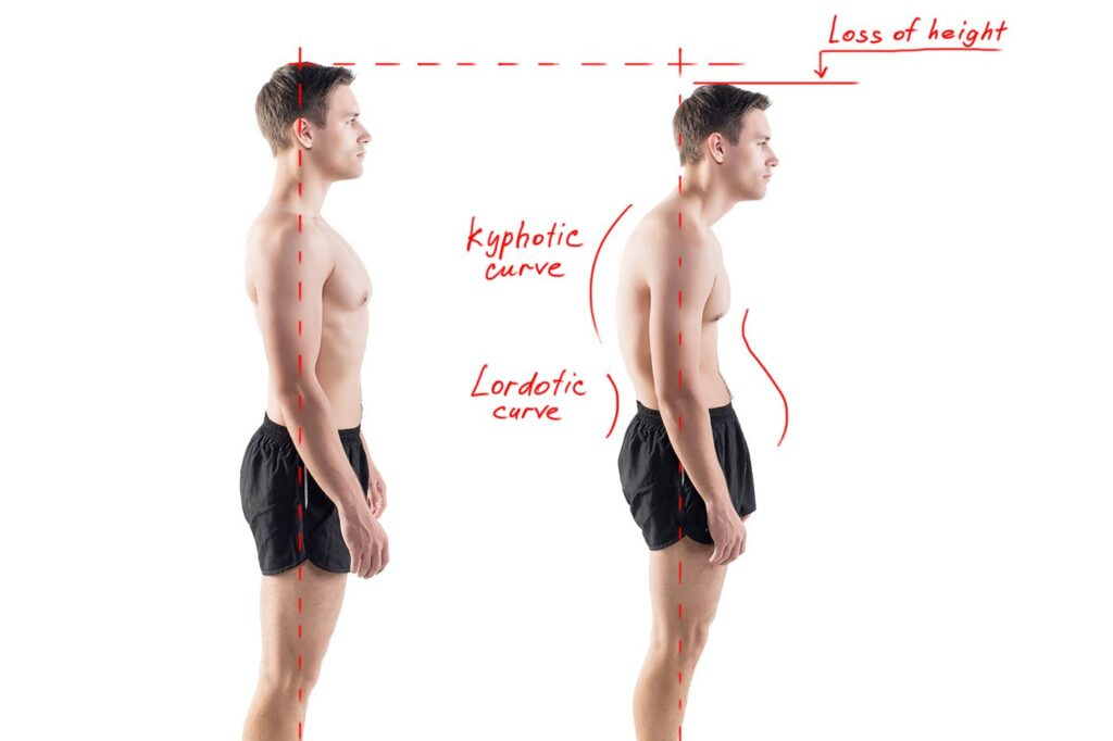 hyper kyphosis