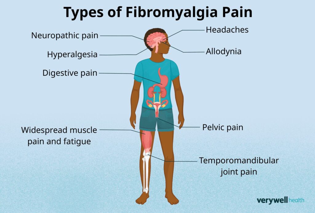 fibromyalgia
