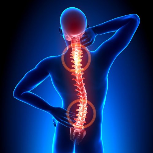 Back and neck pain illustration for Complete Spine Solutions chiropractic care in Tucker, GA