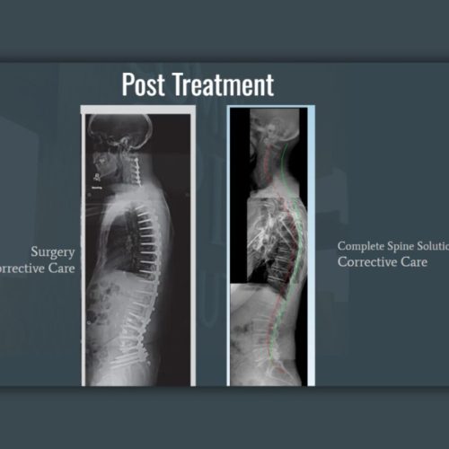 spine surgery alternative